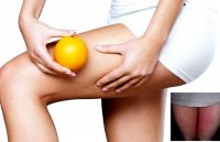 Jock itch home remedy recipe